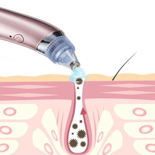 Imported Blackhead & Acne Pore Cleanser Removal kit - Image 5